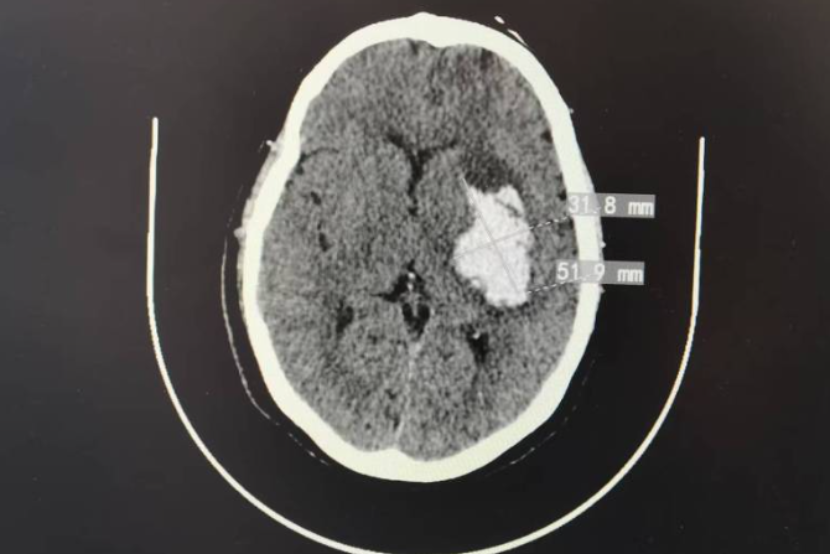 又成功一例!精准!微创!
