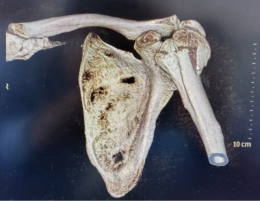 一场车祸，险些让他失去抬臂的自由……