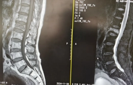 【微创兴院】我院骨科连续开展机器人导航下经皮穿刺腰椎骨折内固定手术