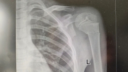 【微创骨科•新突破】“针”不错！真功夫！