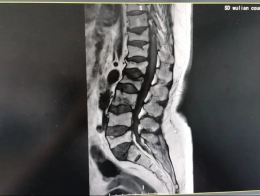 【微创骨科•新突破】我院成功开展首例DSA透视下经皮穿刺脊柱后凸成形术！