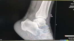 【微创骨科•新突破】“镜”显神通,让您“脚踏实地”！