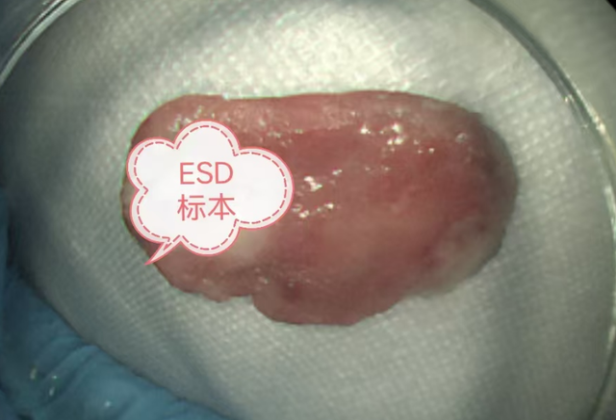 基层“哨兵”+院内“尖兵”：赢了！