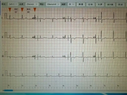 刘女士的惊险一步 被医生精准拦下！