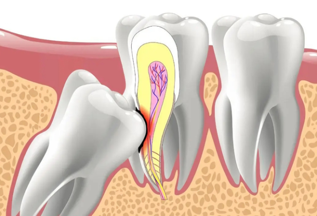 智齿总发炎却不敢拔，最后会咋样？
